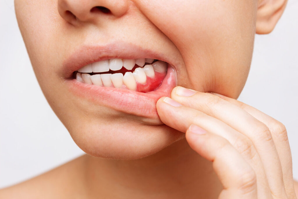 Gum Health Periodontal Disease Treatment