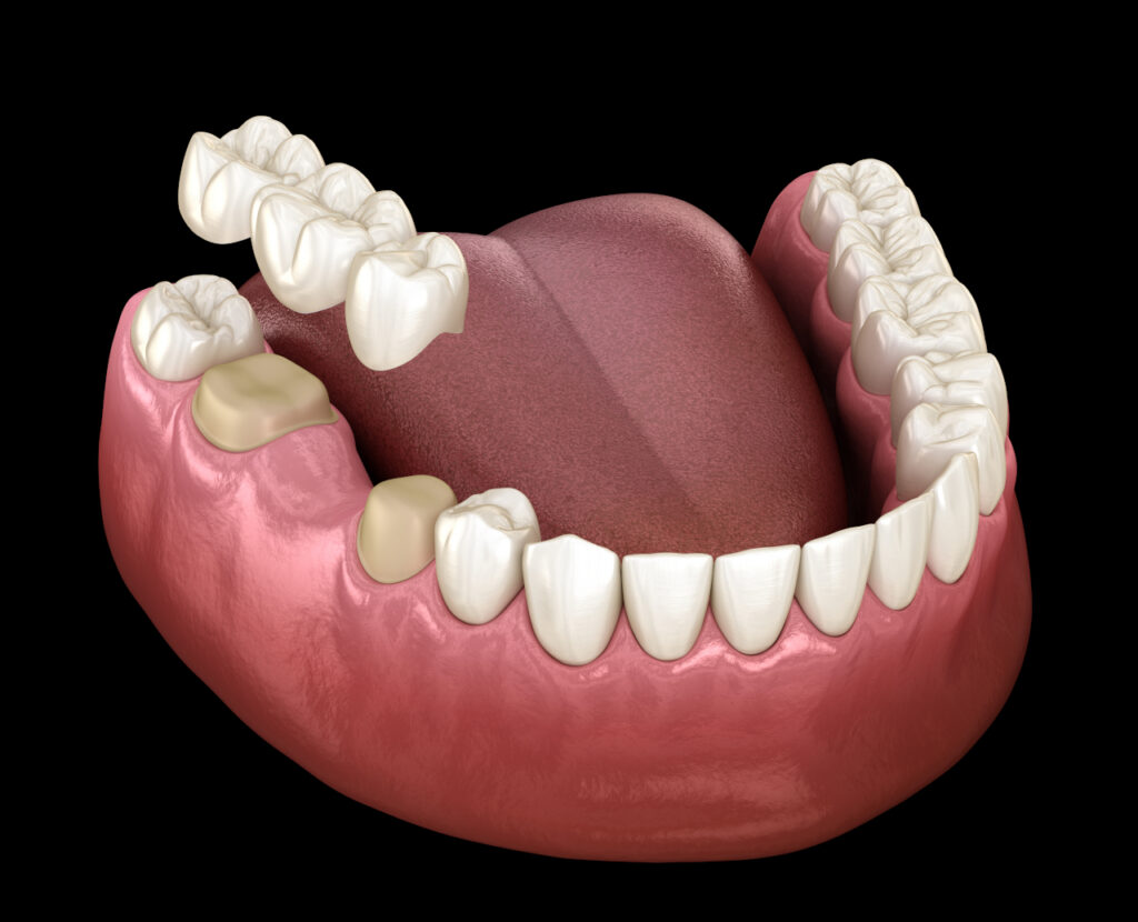 Dental Crowns and Bridges in Dundee, MI: Restoring Strength, Function, and Confidence