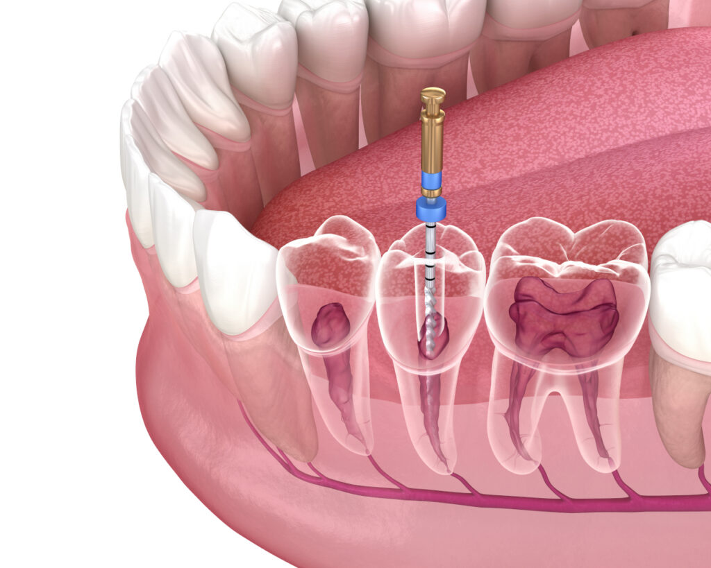 Root Canal Therapy in Dundee, MI: How Modern Dentistry Saves Natural Teeth